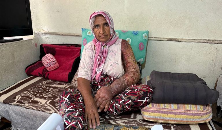 Adana’da kolları şişen bayanın kaygısına deva bulunamıyor
