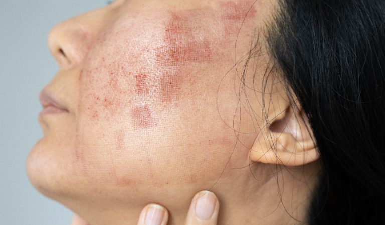Lupus hastalığı hakkında bilmeniz gerekenler Lupus hastalığı hakkında bilmeniz gerekenler